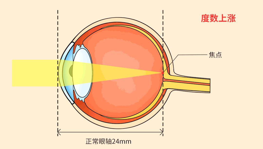 最新儿童眼轴长度正常范围与影响因素概述