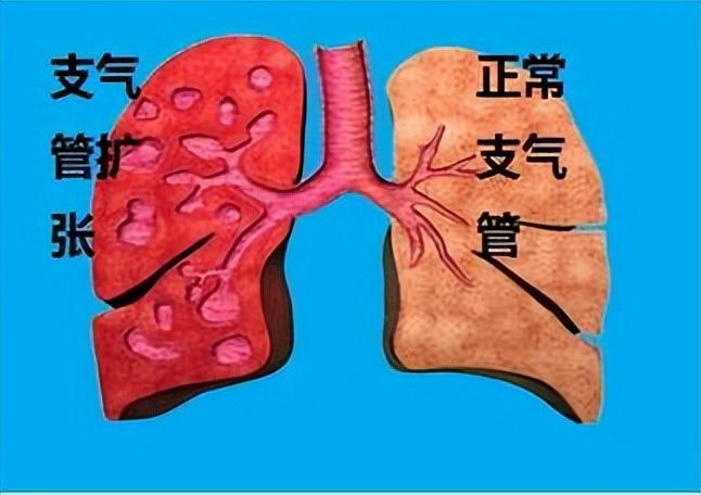 支气管扩张最新疗法，通往更优质生活的希望之门